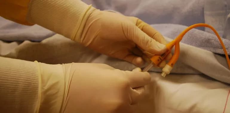 Zakładanie cewnika u mężczyzn: co warto wiedzieć o bólu i dyskomforcie